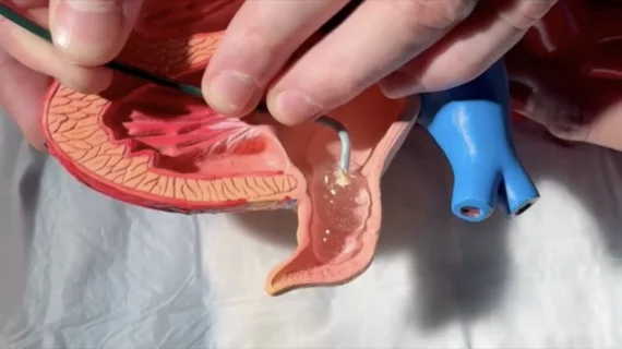 Cardiologist develops new heart device that uses gel to reduce stroke risk in AFib patients
